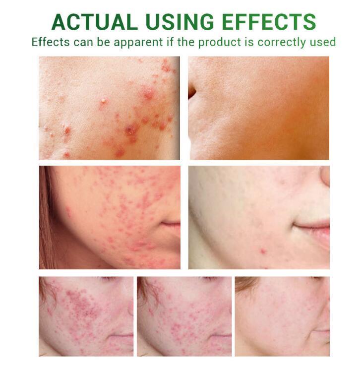 Acne Treatment Serum Facial Repair Oil - Image 7